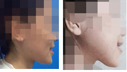 あごの手術を受けた後にあごがゆがんだと主張する中国人女性の整形前（写真左）と整形後の様子だ。写真は当事者が自発的に提供した。
