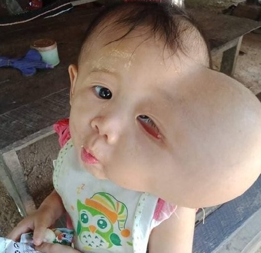 韓国のＢＩＯ整形外科シン・ヨンホ院長が最初に受け取ったミャンマーのクリスティちゃんの写真。［写真　ＢＩＯ整形外科］