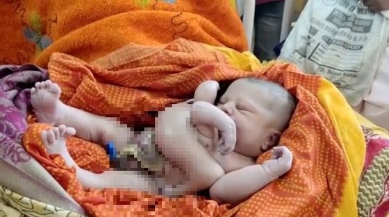 １７日、インド東部のサダル病院で手足がそれぞれ４本ずつある赤ちゃんが生まれた。［写真　インターネット　キャプチャー］