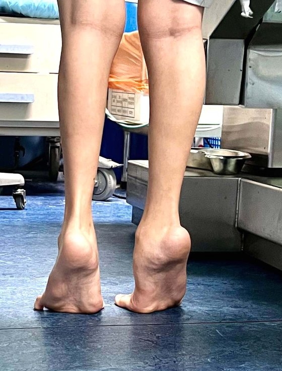 フニンプウィンエイさんは生まれた時から両足のアキレス腱の筋と血管が短かった。成長するにつれて足の前面とかかとが内側に曲がり、足の首関節は足の裏側に曲がったという。［写真　グッド・シェパード財団］