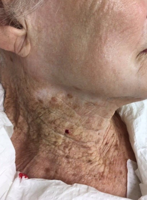 ４０年間、顔にだけ日焼け止めを塗った９０代女性の肌の状態［写真　欧州皮膚科学会誌　キャプチャー］