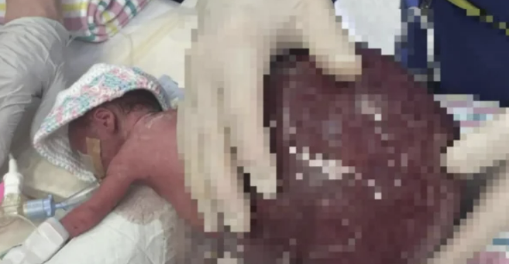 ８月９日、オーストラリアで自分の身体の２倍を超えるこぶが尾骨についたまま生まれた新生児が、６時間の手術の末に奇跡のように生き返った。［写真　メーター・マザーズ病院］