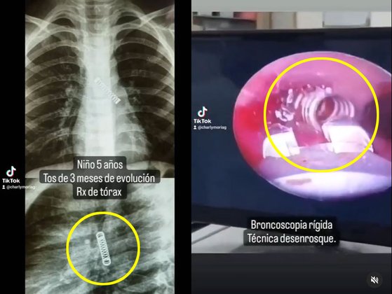 パラグアイ５歳の男の子の肺から見つかった、全長３センチになるスプリング。［写真　Ｃａｒｌｏｓ　Ｍｏｒｉｎｉｇｏ インスタグラム　キャプチャー］