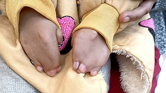 テンリンシシャちゃんは先天的に手足の指がくっついている合指症だ。写真＝キム・ヨンミ氏