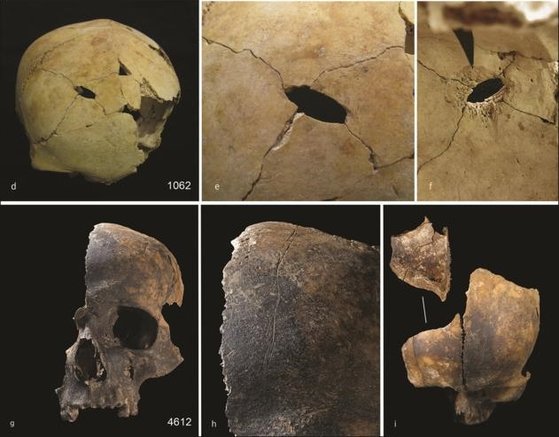英国南西部で初期青銅器遺跡から発見された頭蓋骨の外傷の様子。あちこちに強い衝撃で割れた穴や道具を使って切断した跡が残っている。［写真　学術誌「アンティクィティ」］