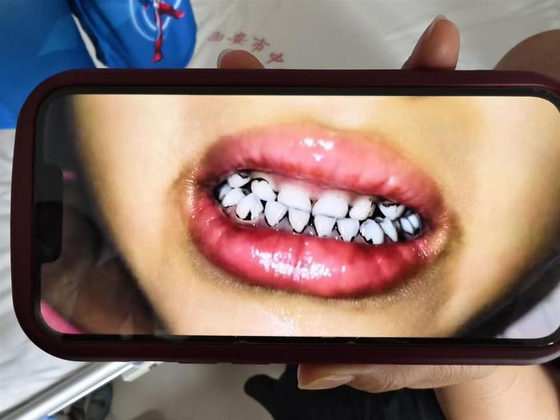 中国で鉛中毒の疑いで歯の一部が黒に変色した幼稚園の園児。［写真　聯合ニュース］