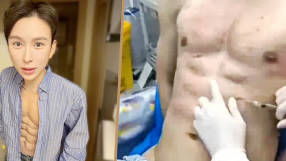   人工の腹筋を作るためにおよそ400万元を費やした中国人男性［SCMP キャプチャー］