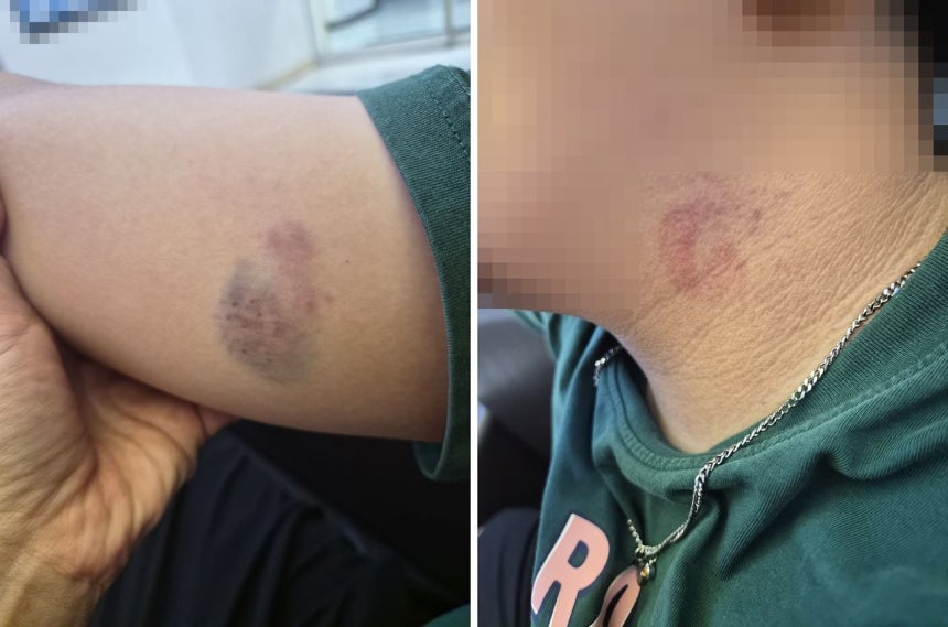 仁川（インチョン）の特別支援学校に通うA君の体にできたあざ。［写真 保護者提供］